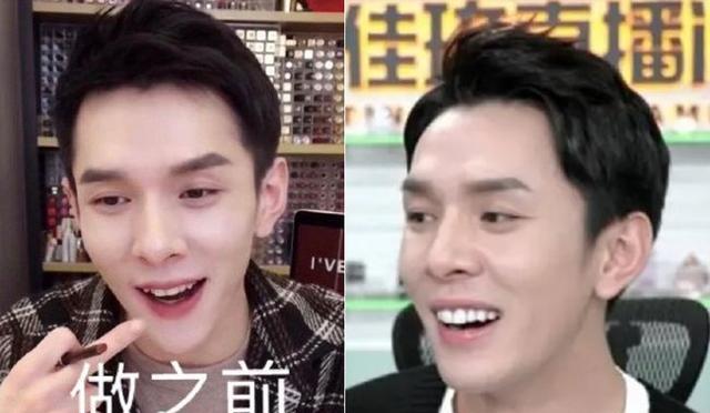 嘴包不住牙,牙龈萎缩发黑,明星假牙后遗症终于藏不住了!