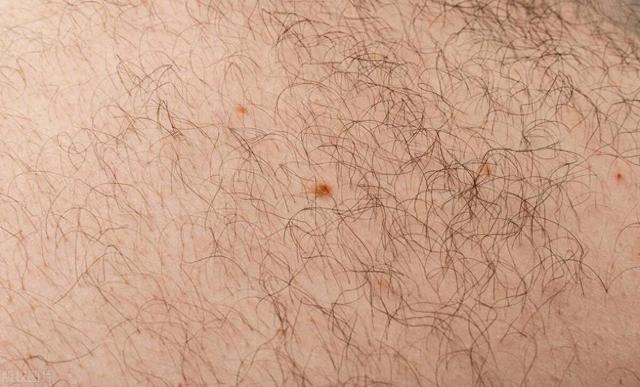 女性屁股中间毛太多，正常吗？能不能直接剃掉？医生告诉你答案