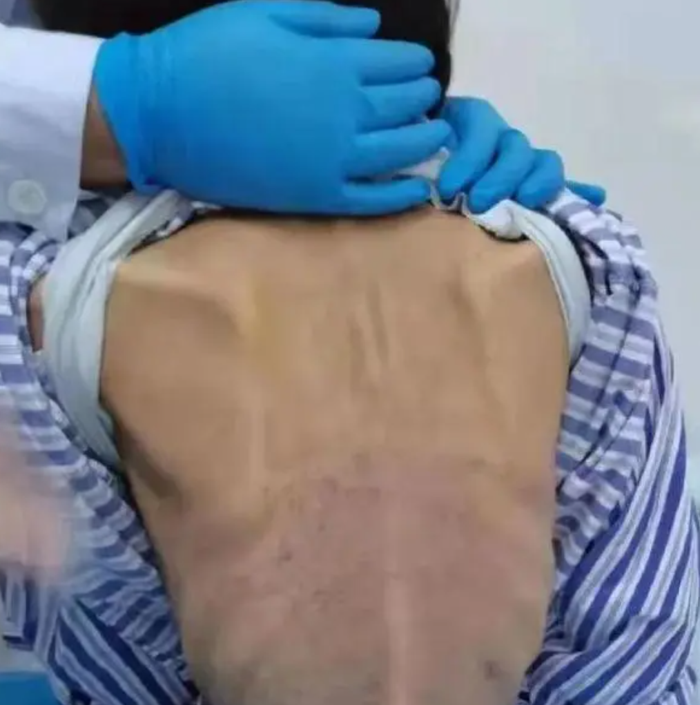 太吓人!女子体重50斤仍在减肥,网友:真怕她跳着跳着散架了