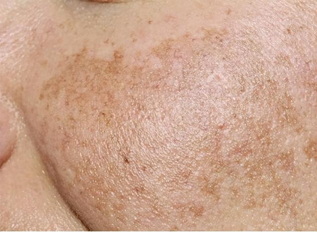 脸上有斑的看过来!选用这些方法,让肌肤变得更白嫩