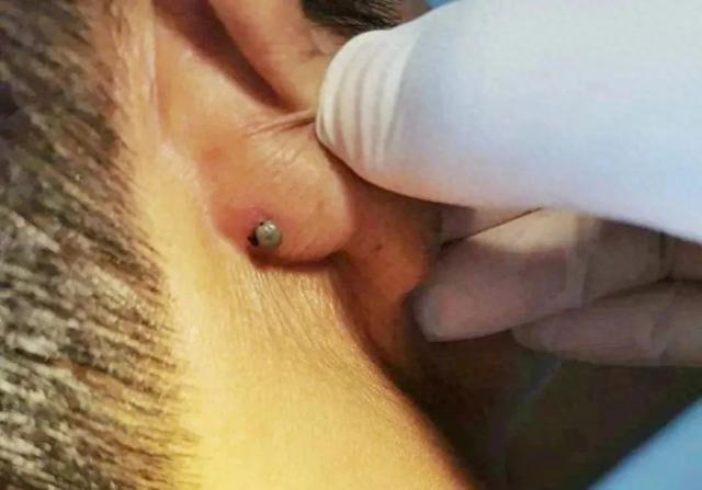 踏青时小心这个“黑点”,严重可致命!正在高发期…