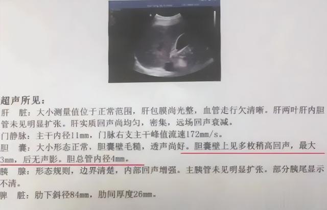 胆囊息肉，其实是胆囊被垃圾堵住了，一方4步走，冲走垃圾消息肉