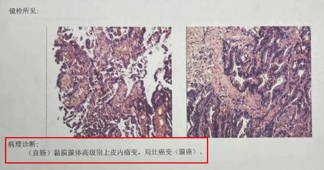 明明很重视养生，却被确诊癌症！医生：这个吃饭习惯害了她