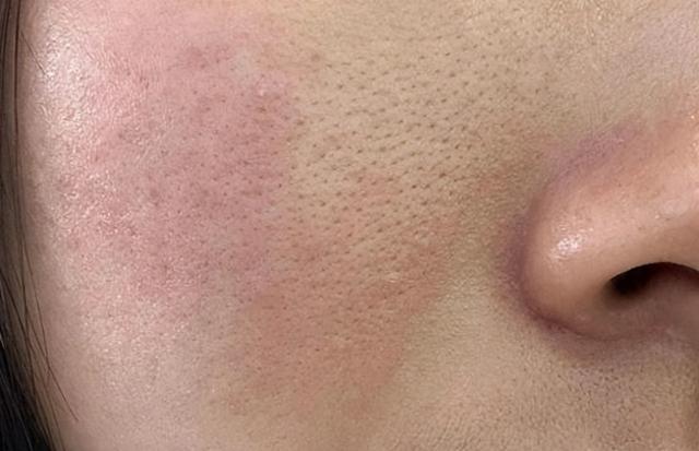 如何预防斑点再生?生活习惯与护肤建议