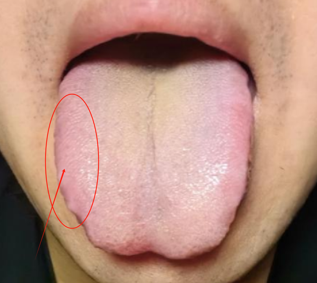 舌诊案例：男人最怕补成这样的舌头，堵住气血往下充盈的通道了