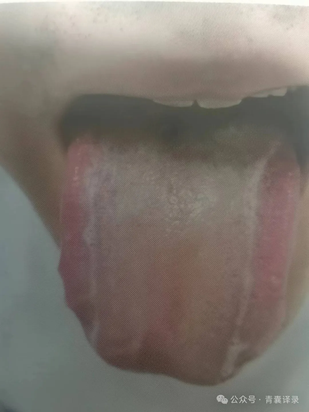 快看看你的舌头有没有这种肝郁线