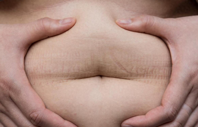 看着不胖就安全了？内脏脂肪这个“隐形杀手”，比单纯肥胖更可怕