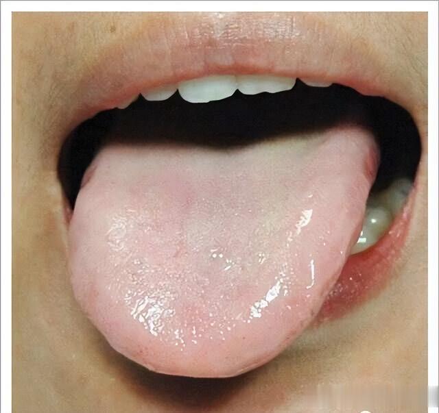 虚汗、自汗、满头大汗，玉屏风散这样搭，益气固表，敛汗止汗