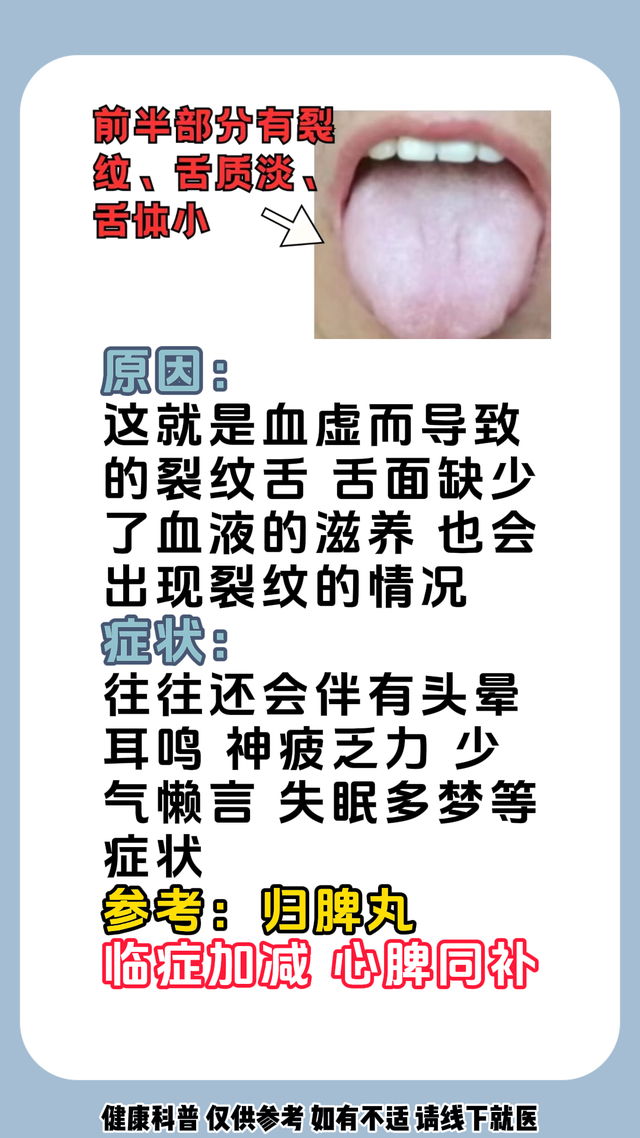 舌头有裂纹，就是肾精亏虚?教你认识这四种裂纹舌简单一招修复它