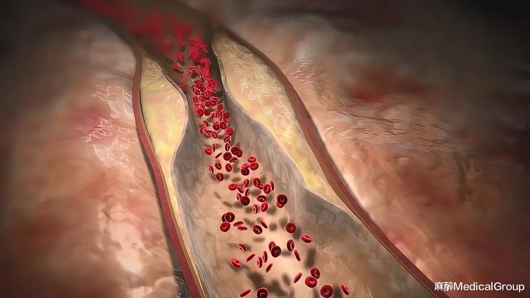 一文详解肌间静脉血栓