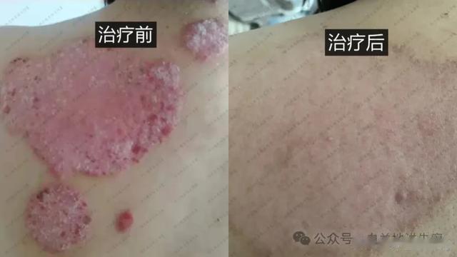 3块钱一斤的绿豆，用来对抗银屑病，是个好帮手！