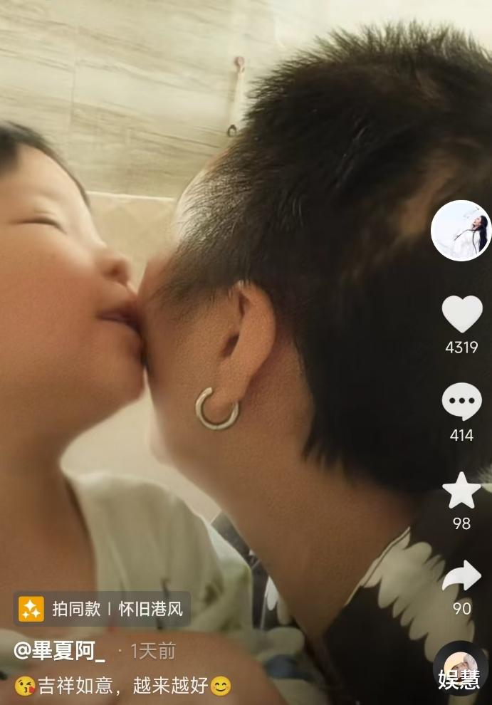 歌手毕夏晒康复进程,头骨像是少了一半,憔悴露面令粉丝心疼不已