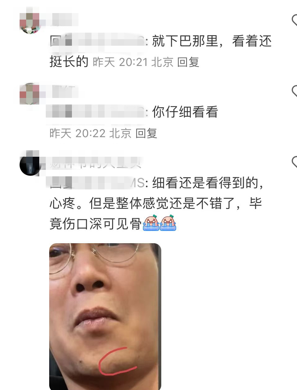 陈奕迅受伤一个月首露面,下巴缝了30针的疤痕好长,恢复情况良好