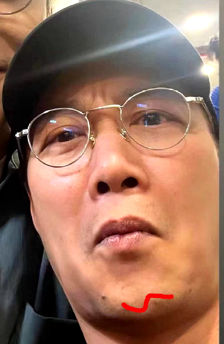 陈奕迅受伤一个月首露面,下巴缝了30针的疤痕好长,恢复情况良好