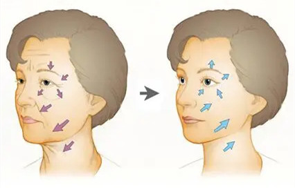 面部提升方式有哪些？为什么很多人会选择埋线提升？整形医生胡可