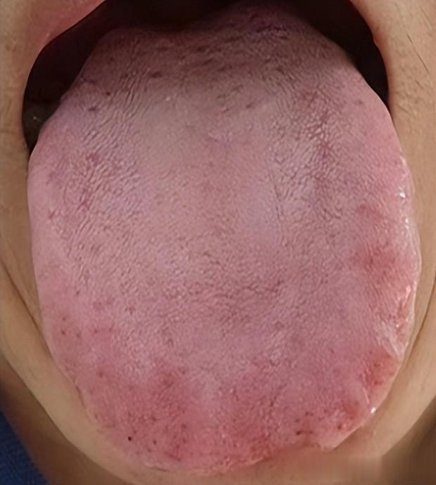 延长海绵体时间,健脾、固摄、安神三步走,值得学习的实战经验