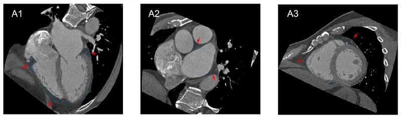 揭秘心脏脂肪与心律失常的深层联系：跨学科研究开辟治疗新路径