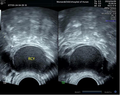 “不可忽视的痛”子宫内膜异位症