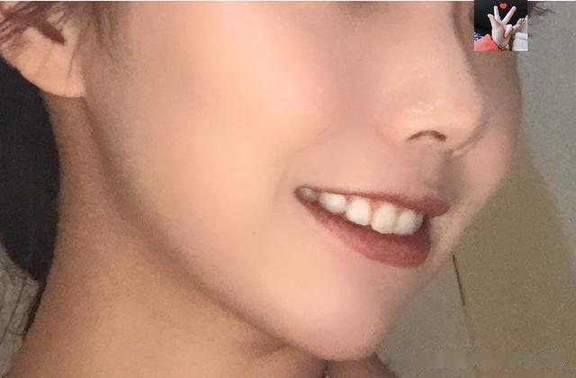 女孩打“假童颜针”变僵、变硬变馒化脸,修复后苹果肌真好看