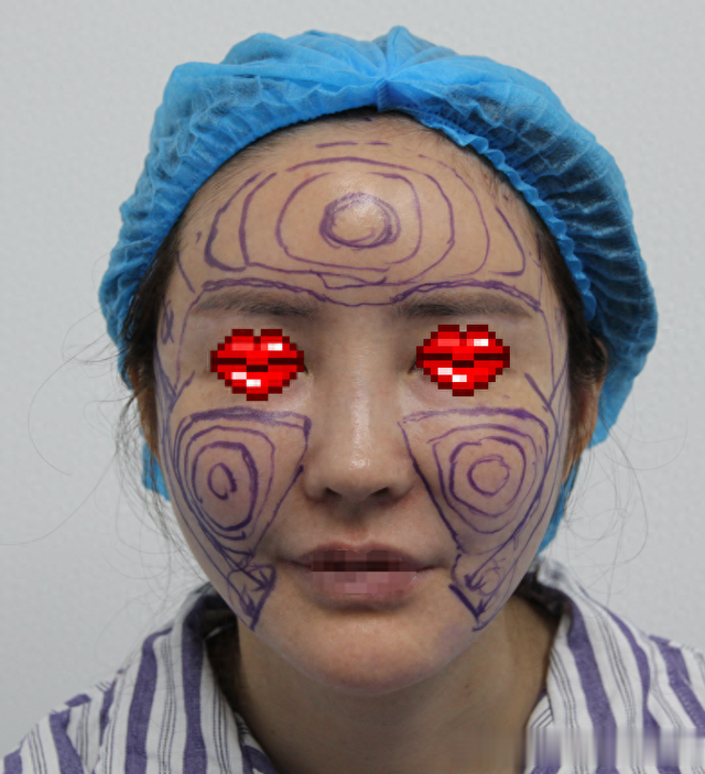 28岁女孩连续3次脂肪填充丰面，把自己填成馒化脸，10年后来修复