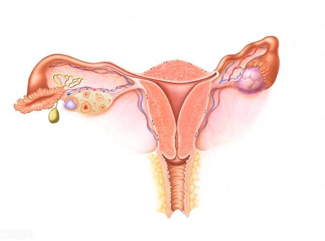 2个卵巢囊肿外敷方，方便有效，告别每天的汤汤水水！