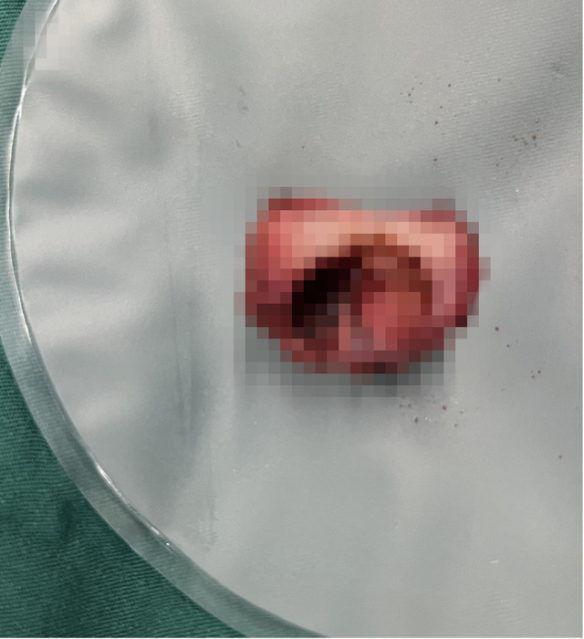 20岁女孩痛到满床打滚!医生:她比别人多一个……