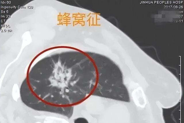 肺CT这6种表现，要重视，千万不可掉以轻心，以免追悔莫及！