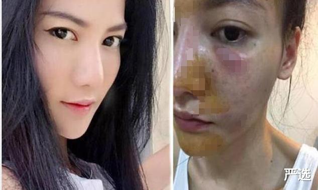 女子为变白狂打6年美白针,如今变成什么样了?网友:不敢相信