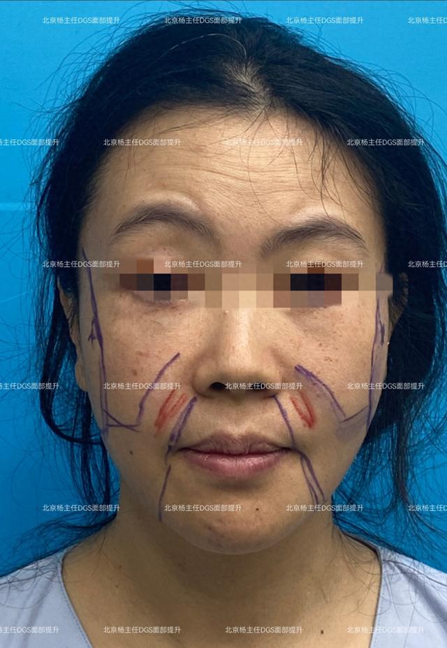 43岁女士，人生第一次做拉皮提升，术后60天，像换了一张脸！