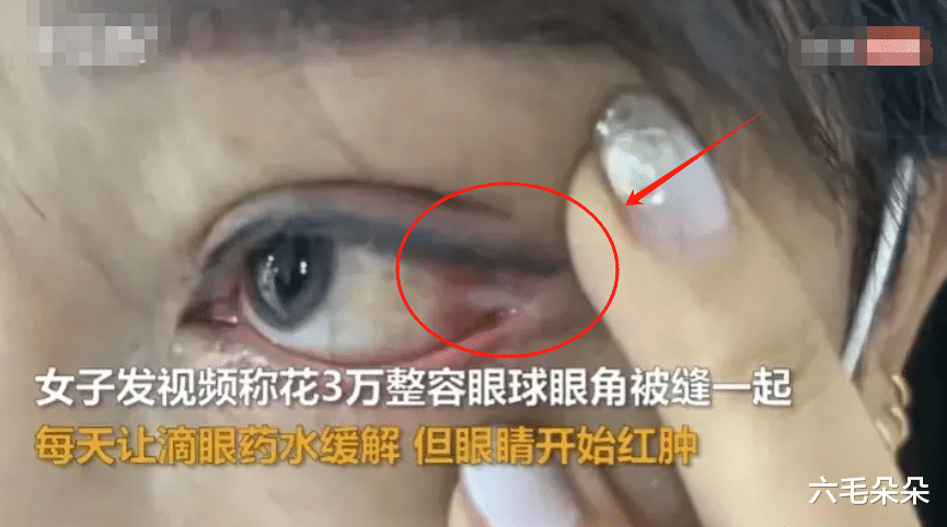 女子花3万割双眼皮，眼球与眼尾被缝一起无法转，整形医院只赔1万