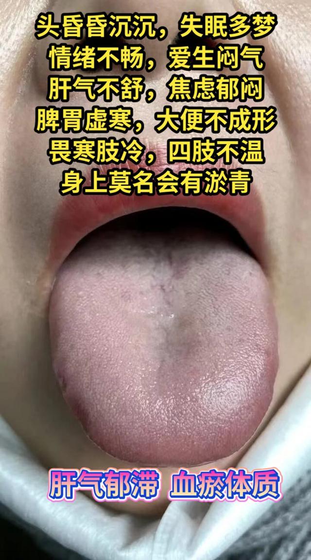 漆主任男妇科——舌诊经验分享：气血虚，里阳不足，寒湿化热