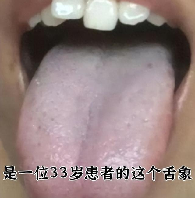 潘医生舌诊—实战分析:心肝火旺,脾肾两虚,湿气重