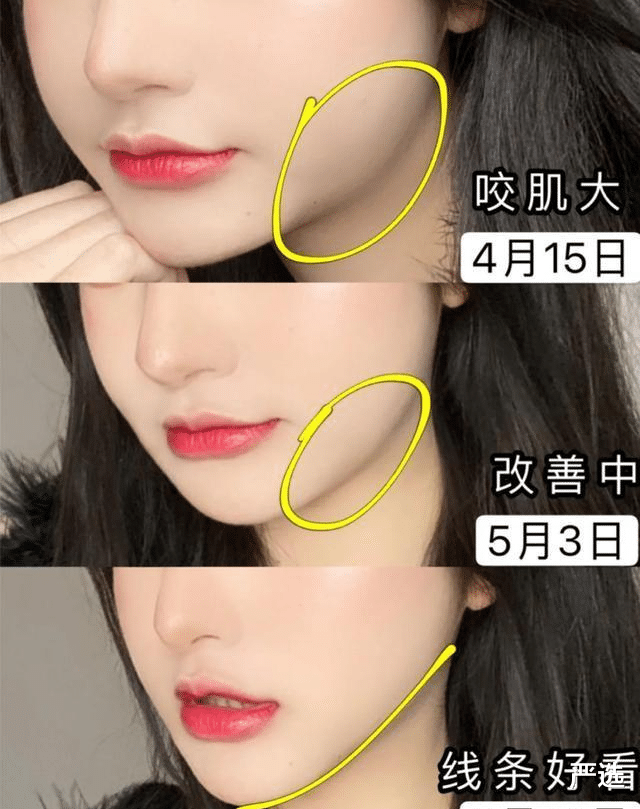 那些尝试“美容针”的女人,如今变成什么样了?过来人说出心里话