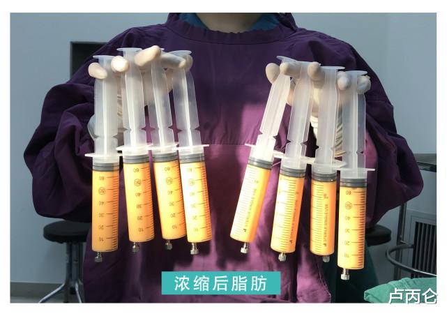 脂肪填充一次包成活?我劝你谨慎