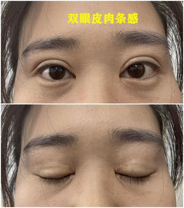 双眼皮术后肉条感怎么办？真性肉条可以通过双眼皮修复改善。