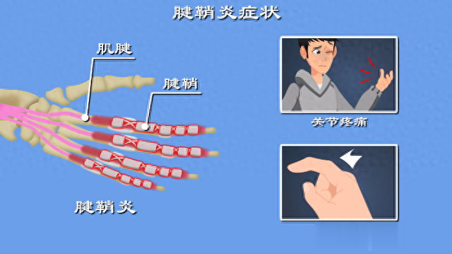 腱鞘炎是筋伤的痛，一个神通广大中成药可止