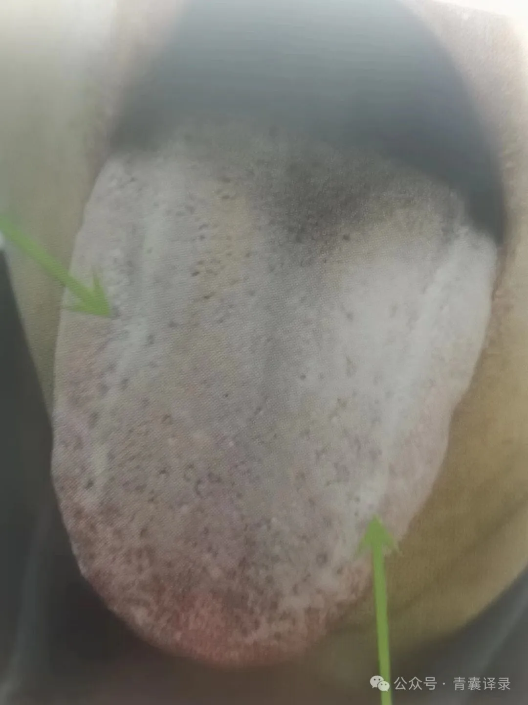 快看看你的舌头有没有这种肝郁线