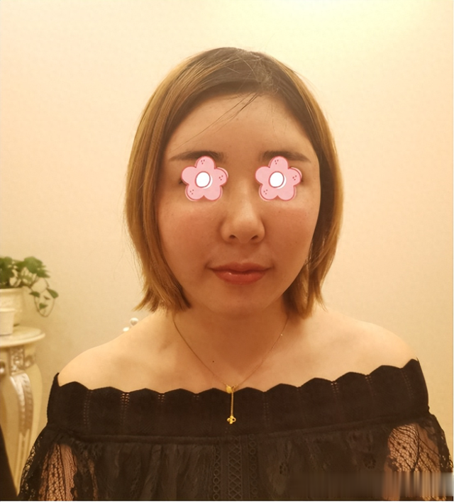 小美女苹果肌填充生长因子失败后长成馒化脸，来修复恢复自然