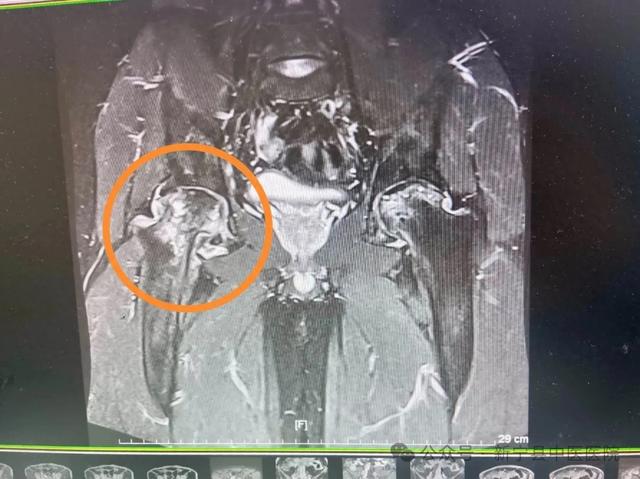 36岁男子股骨头坏死!他们成功行髋关节置换术让他脱拐行走