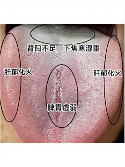 舌根厚腻，肾阳不足，但桂附、金匮补阳却无效，答案全在舌头上了