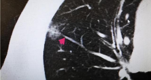 肺CT这6种表现，要重视，千万不可掉以轻心，以免追悔莫及！