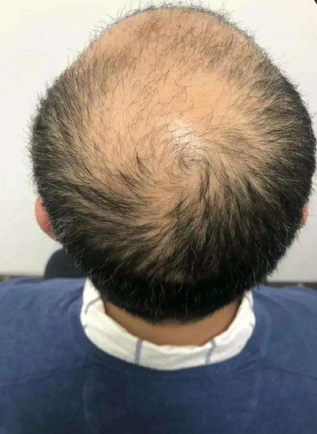 好奇怪！为何东北地区秃顶掉头发的少，南方小伙都成了秃顶小老头