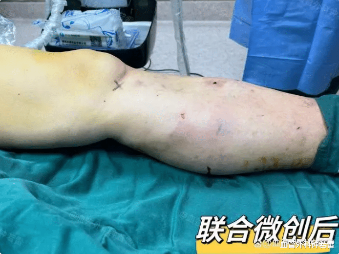 46岁初中老师,花一个月工资做静脉曲张微创,30分钟后腿成了这样