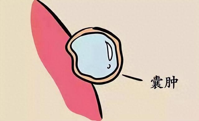 一个专方，堪称洗涤剂，清全身痰瘀，通一身气血，破开囊肿