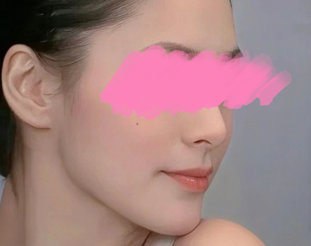 整形医生芦隽轩解析什么是面部平整度？