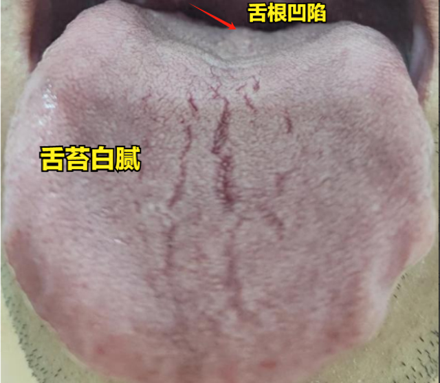 千万注意：如果你有裂纹舌，舌苔又白，绝对不能直接去健脾祛湿。