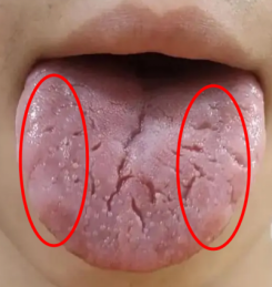 大错特错!裂纹舌不光是脾虚,1次性教会你,通过裂纹找病根!