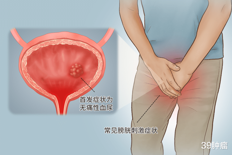 膀胱癌变，尿液先知？上厕所出现4种异常，抽空检查下膀胱