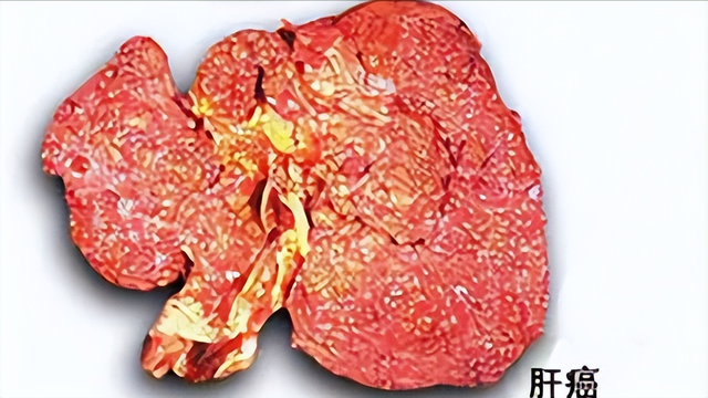 全球近一半肝癌在中国，医生建议：家中的2种食物，尽早撤下餐桌