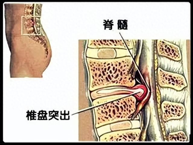 百损丸治疗腰椎椎间盘滑脱、突出、膨出，骨质增生、骨质疏松等